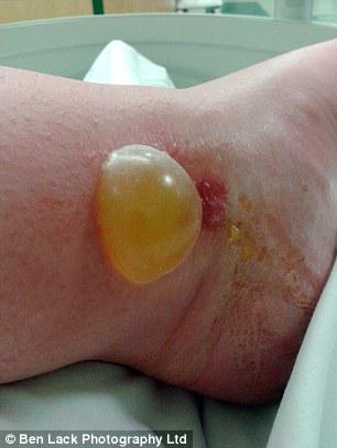 Dwa razy trafiła do szpitala po ukąszeniu przez pająka