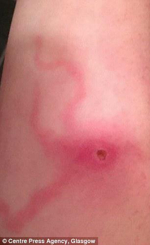 Myślała, że cierpi na grypę, w rzeczywistości ugryzł ją pająk