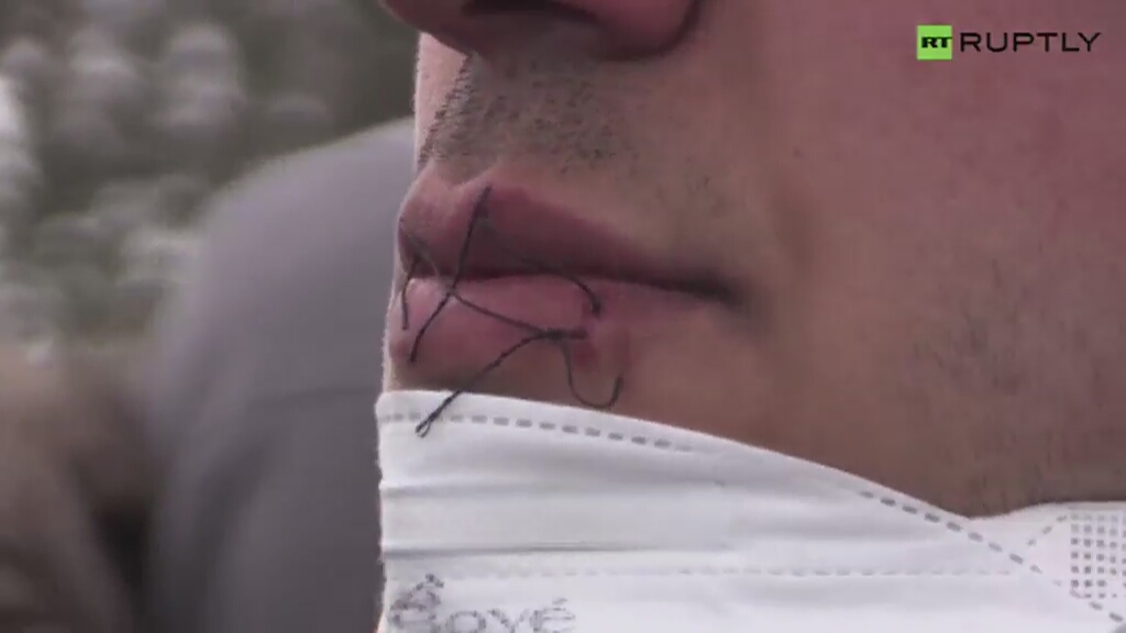 Uchodźcy zaszyli sobie usta w ramach protestu przeciwko likwidacji obozu w Calais