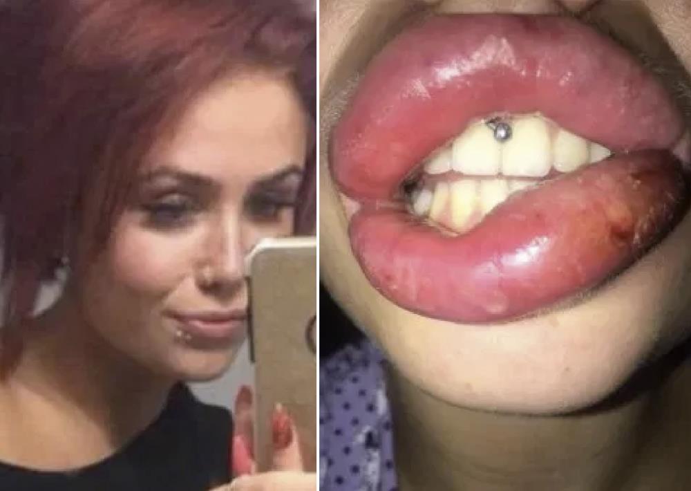 Nastolatka zapłaciła £170 za zabieg powiększania ust i przeżyła koszmar