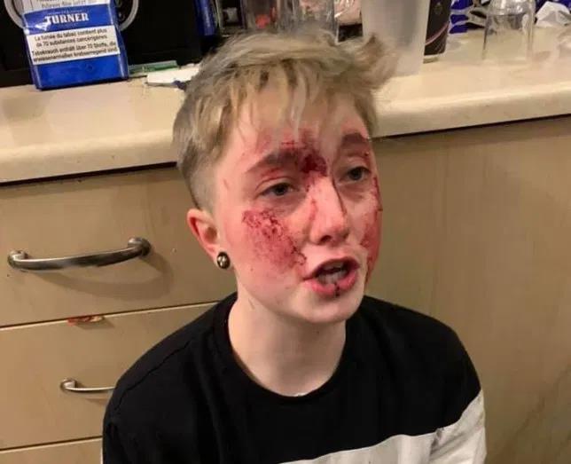 Kobieta brutalnie pobita przez 2 mężczyzn dlatego, że jest lesbijką. Wcześniej zaatakowano ją już 5 razy