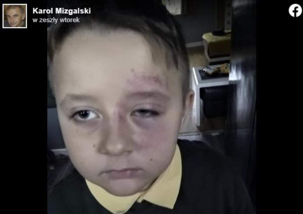 7-latek brutalnie pobity w brytyjskiej szkole tylko dlatego, że jest Polakiem