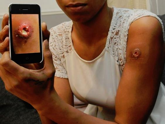 Kobieta spędziła 4 dni w szpitalu po ugryzieniu przez pająka