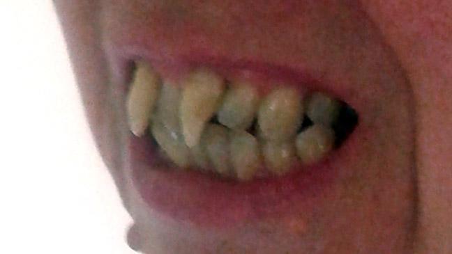 49-latka dostała 25 tys. funtów odszkodowania za zepsute zęby – wyglądała jak wampir