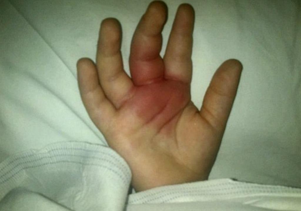 Pająk w bananach kupionych w Aldim ukąsił dwuletniego chłopca i spowodował czasowy paraliż