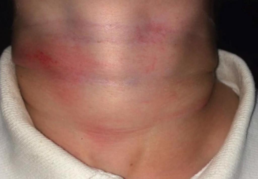 Pięciolatek był duszony skakanką na szkolnym placu zabaw