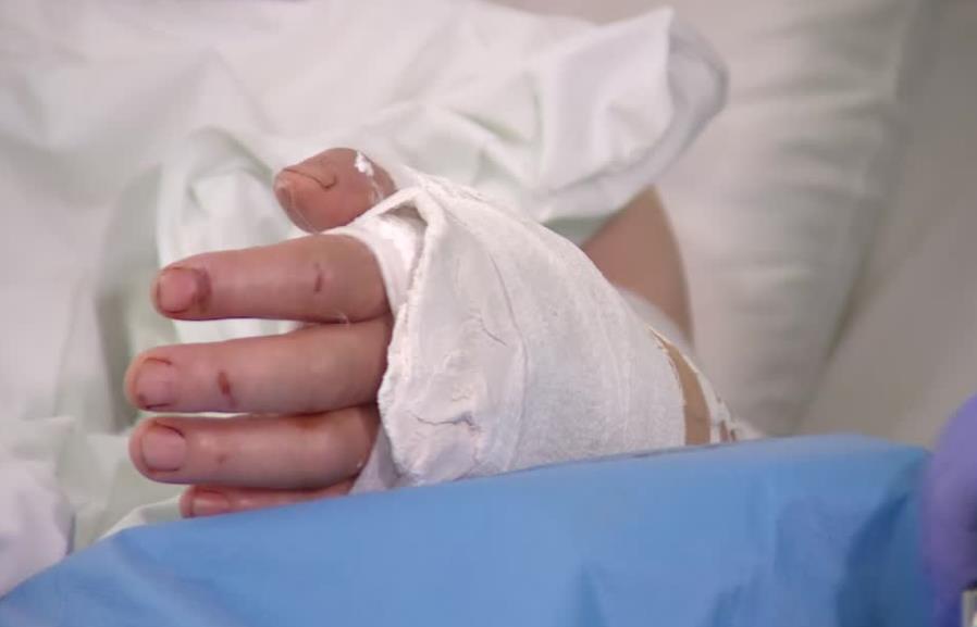 Sukces wrocławskich lekarzy. Przeszczepili dłoń pacjentowi, który nigdy jej nie miał