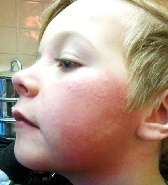 10-latek z alergią na zimno przeprowadził się z rodziną do Australii, by móc normalnie żyć