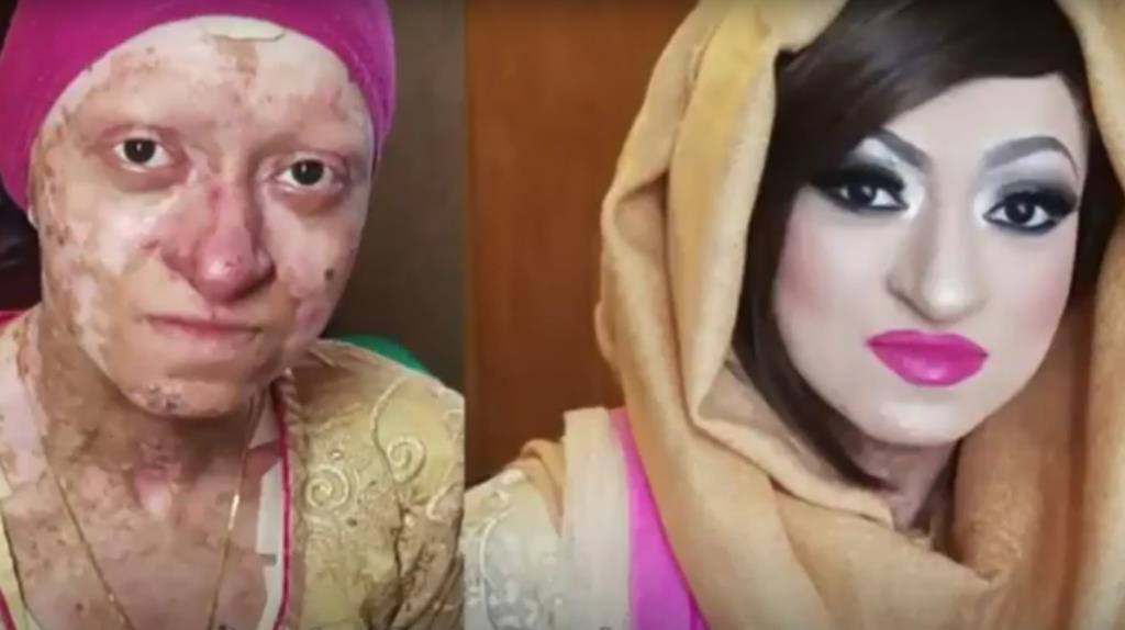 Cierpiąca na rzadką chorobę mieszkanka Birmingham walczy o to, by żyć normalnie