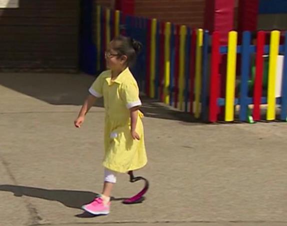 Siedmiolatka z Birmingham, której amputowano nogę otrzymała nową protezę