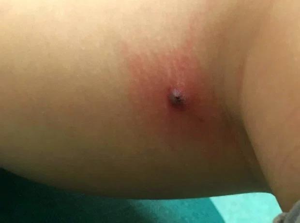 Pająk zagnieździł się w nodze ośmioletniej dziewczynki