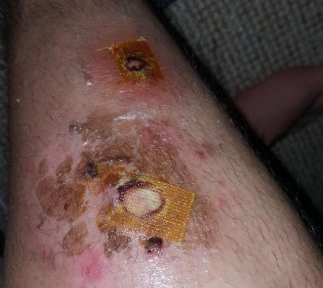 Jadowity pająk ukąsił mężczyznę w jego własnym łóżku